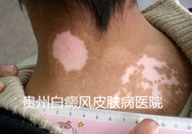 诊断白癜风有哪些依据?
