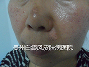 我们该怎样预防白癜风呢