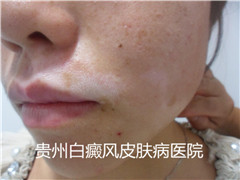 白癜风(白斑病)患者的饮食需要吃什么