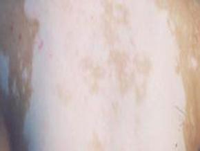 女性胸部白癜风应怎样护理